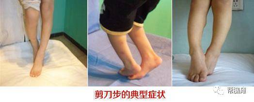 痉挛型脑瘫 康复训练 剪刀步态_髋关节训练椅