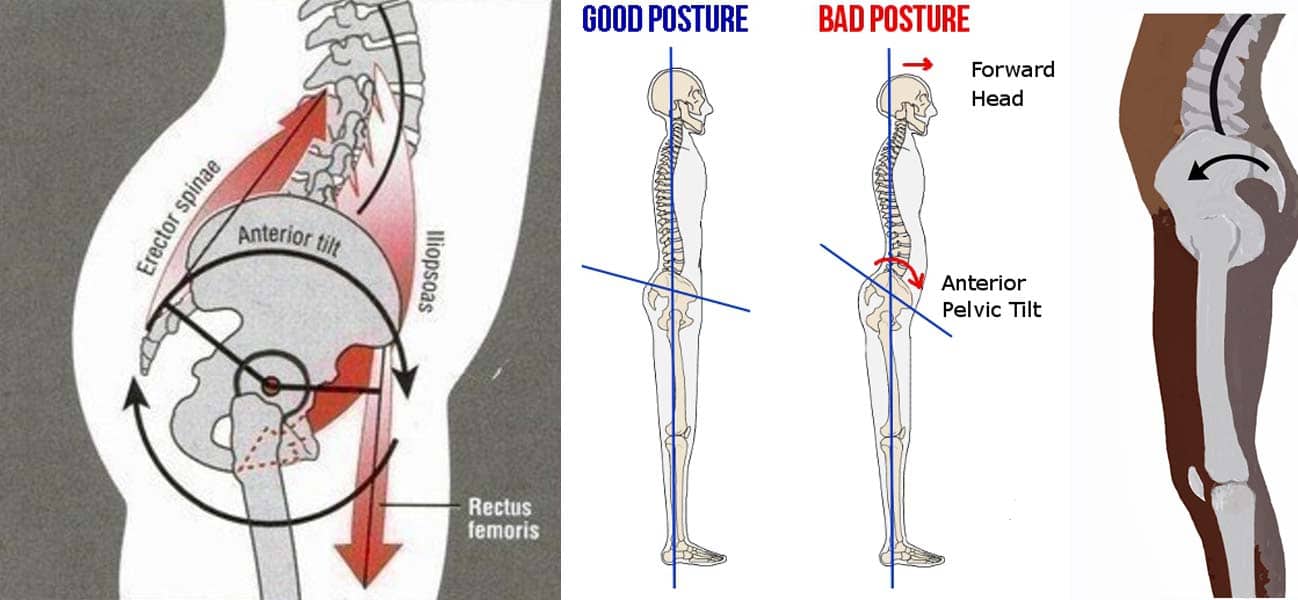 髋关节训练椅_骨盆前倾改善方法_骨盆前倾原因
