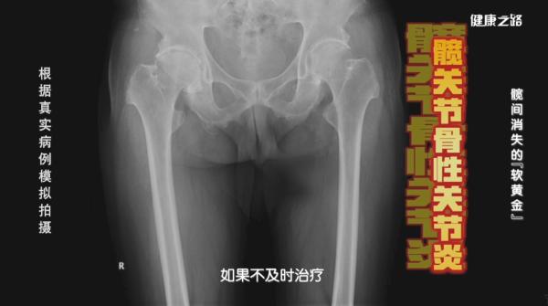 髋关节训练椅_运动损伤髋关节怎么办_髋关节骨性关节炎症状