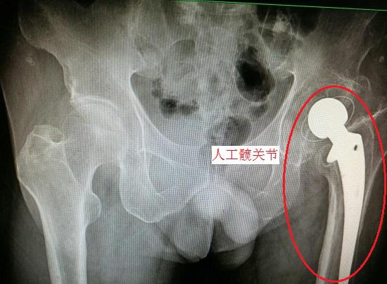 开yunapp体育官网入口下载手机版 全髋关节置换术后不良步态的纠正性训练