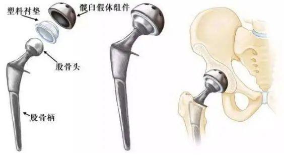 髋关节训练椅__ 髋关节置换手术过程 