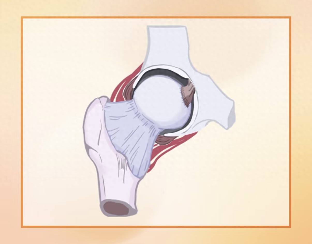 髋关节骨关节炎预防_髋关节训练椅_髋关节疼痛信号
