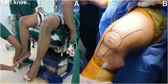 股四头肌肌腱解剖_股四头肌肌腱撕裂症状_股四头肌训练椅